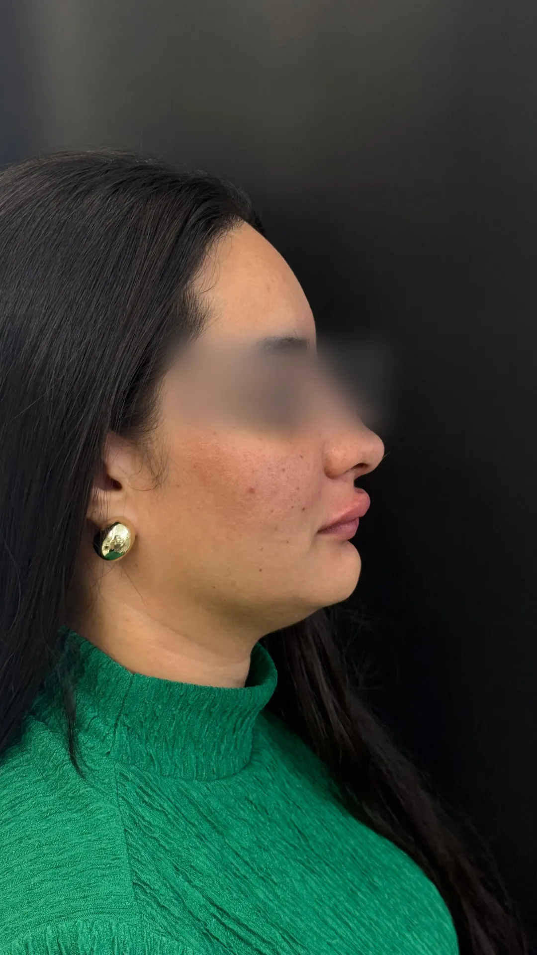 Resultado de tratamento odontológico e estético realizado pela Dra. Júlia Hummel